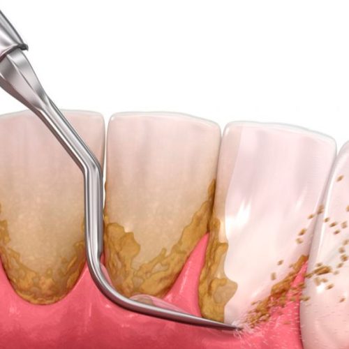 curetaje en clínicas dentales Natura