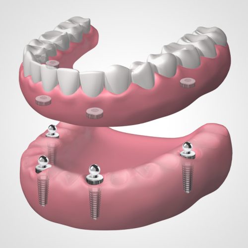 Dentaduras completas extraíbles