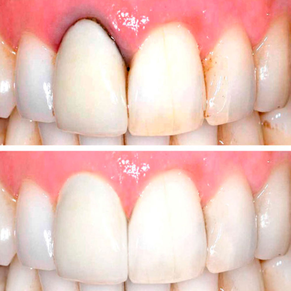 Prótesis de zirconio en Clínica dental natura